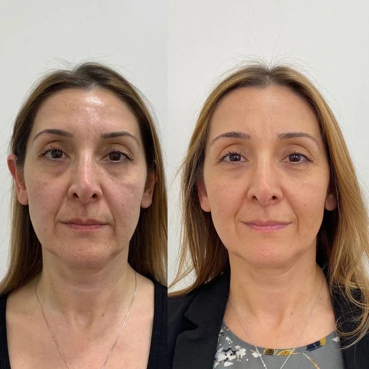 Patricia L. Ultherapy