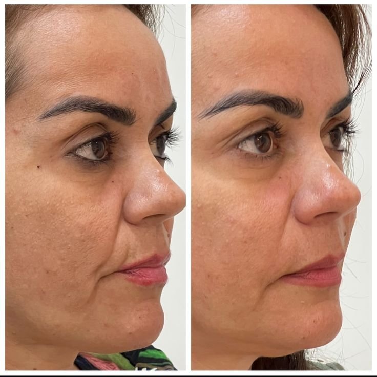 Sofía G. Ultherapy
